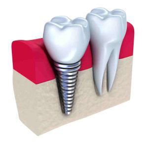 shutterstock_74442769_Single_Implant_Crowns